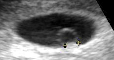 Contents in the cavity of the uterus seen at approximately 5 weeks of gestational age