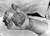 La mano coperta di vesciche e bruciata di Harry K. Daghlian, fotografata il 30 agosto 1945, dopo aver ricevuto la sua dose fatale di radiazioni. Morì 16 giorni dopo questa foto.