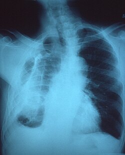 Fibrothorax on chest x-ray