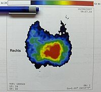 Struma with autonomous adenoma