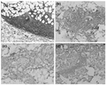 Thumbnail for Blastic plasmacytoid dendritic cell neoplasm