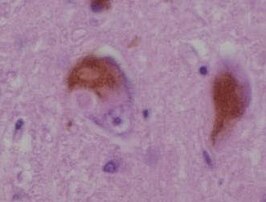 Lewy-lichaampjes onder de microscoop