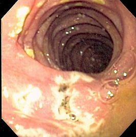 Vele kleine zweren in het distale duodenum van een patiënt met het syndroom van Zollinger-Ellison