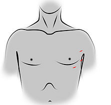 Incisions des orifices de trocarts pour une thymectomie vidéo-assistée par voie gauche.