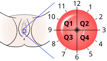 The location of cervical cancer can be described in terms of quadrants, or corresponding to a clock face when the subject is in supine position.