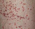 Thumbnail for Immune thrombocytopenic purpura