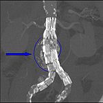 Endovaskulärt reparerat aneurysm (EVAR).