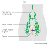 Cervical cancer stage IIIC2