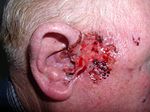 Thumbnail for Basal-cell carcinoma