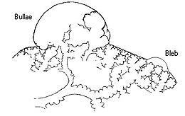 A schematic drawing showing a bulla and a bleb, two lung abnormalities that can lead to pneumothorax