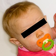 Photo d'un visage d'enfant blond à la peau blanche, dont le nez est légèrement orange. Les yeux ont été masqués sur la photo avant publication.