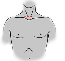 Incision de cervicotomie pour une thymectomie trans-cervicale.