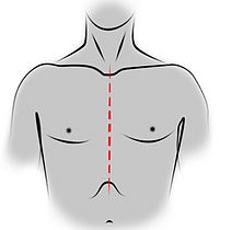 Incision de sternotomie médiane pour une thymectomie trans-sternale.