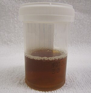 A container half-full with brown-stained urine, characteristic for rhabdomyolysis