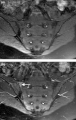 Magnetic resonance images of مفصل عجزي حرقفيs. Shown are T1-weighted semi-coronal magnetic resonance images through the sacroiliac joints (a) before and (b) after intravenous contrast injection. Enhancement is seen at the right sacroiliac joint (arrow, left side of image), indicating active التهاب المفصل العجزي الحرقفي.